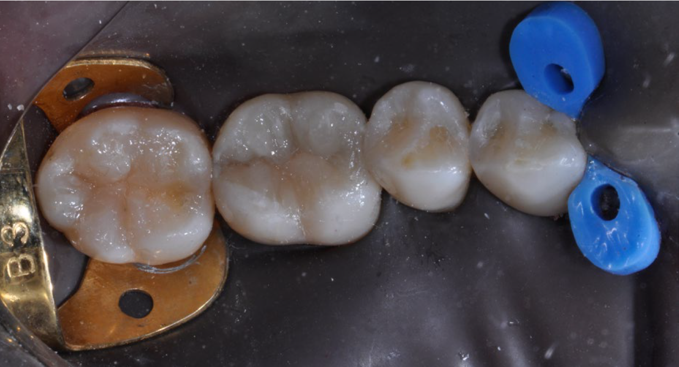 Reabilitação estética de dentes posteriores: dúvida de qual cor em qual dente?