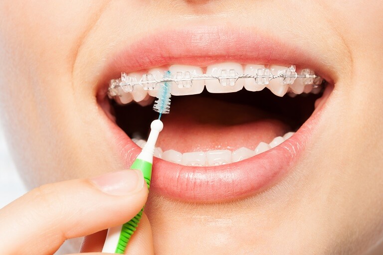Paciente com aparelho fixo fazendo limpeza entre dentes com escovas interdentais.