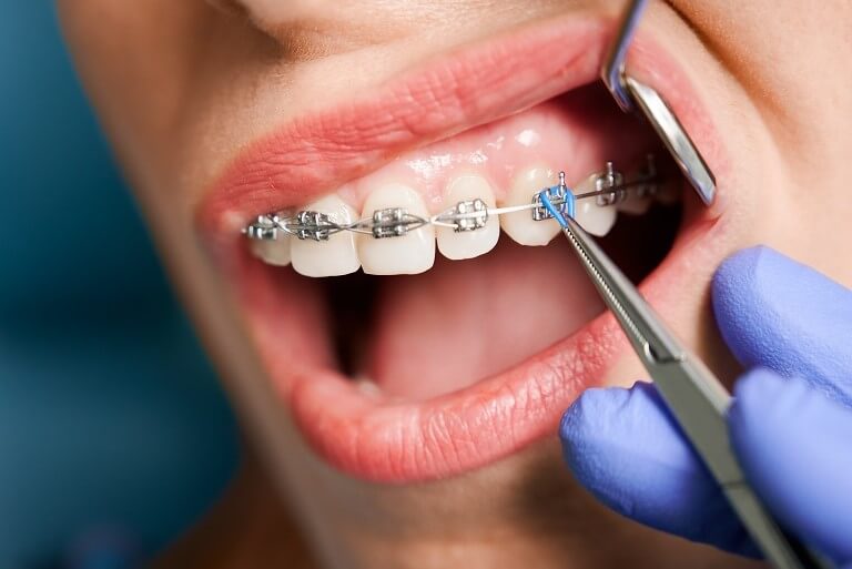 Ortodontista colocando borrachinha de aparelho com pinça porta agulha.